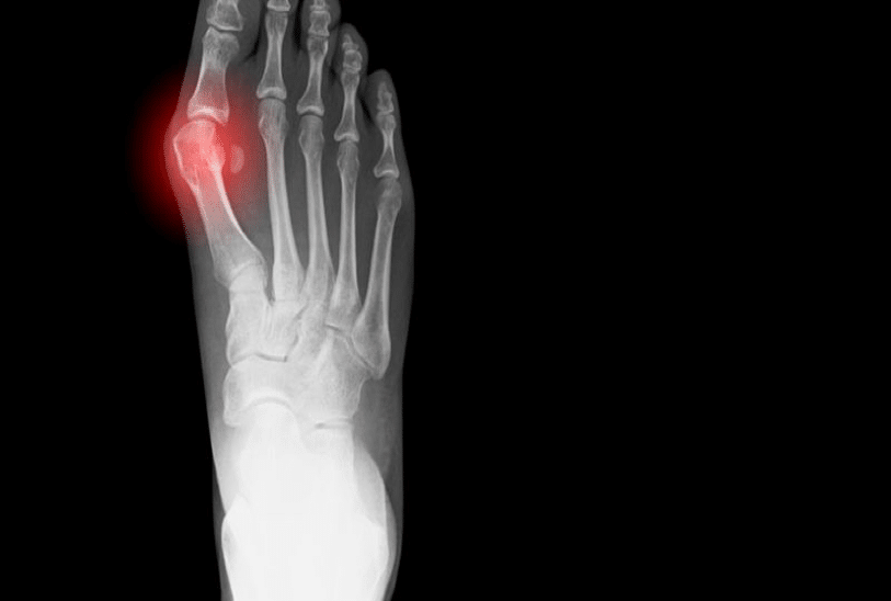 Seaview Orthopaedic Bunion Overview