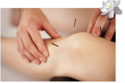 Acupuncture