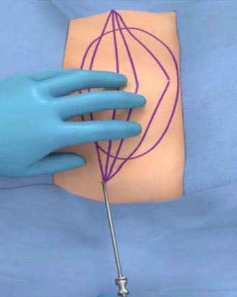 Lipogems